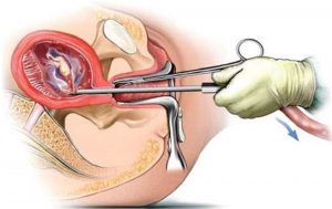 abortion